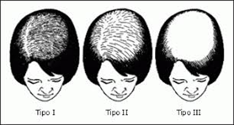 alopecia-androgenetica-femminile